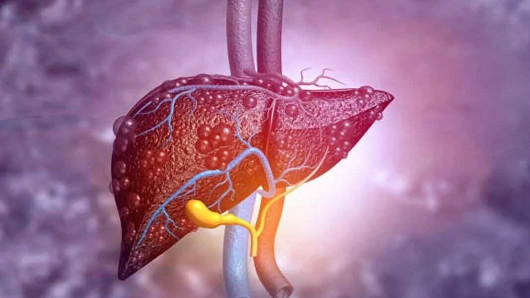 World Liver Day 2022: What Causes Fatty Liver Disease